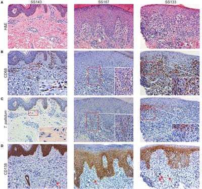 IFNγ Enhances CD64-Potentiated Phagocytosis of Treponema pallidum Opsonized with Human Syphilitic Serum by Human Macrophages